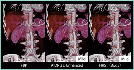 図7　FIRSTにおけるCTAの画質向上（肺血管・腹部血管）：VR画像
