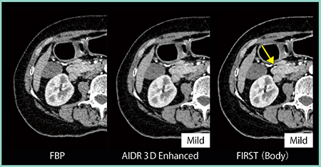 図8　FIRSTにおけるCTAの画質向上（腹部血管）：アキシャル画像