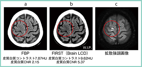 図6　急性期脳梗塞の臨床画像
