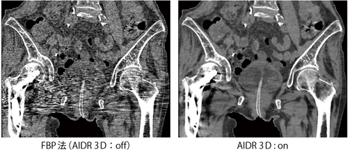 図2　自然呼吸下・体動抑制不能・上肢挙上不能例におけるAIDR 3D 臨床画像例 （データご提供：藤田保健衛生大学病院様）
