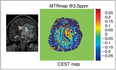 図1　転移性脳腫瘍のCEST効果（W.I.P.） （画像ご提供：京都大学・伏見育崇先生）