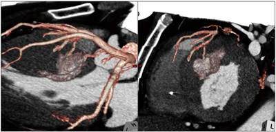 図5　PTSMA直後に施行された冠動脈CT画像