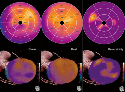 図6　“CT/SPECT心臓フュージョン”を用いた責任冠動脈の同定