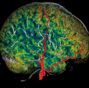 図1　CBFのボリュームデータと血管の重ね合わせ表示による、浅側頭動脈-中大脳動脈吻合（STA-MCAバイパス）術前画像
