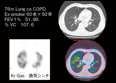 図9　COPD症例におけるVelocity mapと換気シンチグラフィとの比較