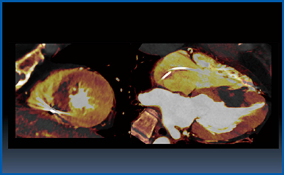 図2　肥大型心筋症の評価 肥大部の様子を4Dイメージで評価可能である。