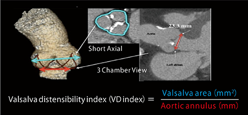 図4　Valsalva distensibility index（VD index）