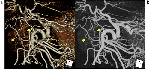 図2　膵十二指腸動脈のアーケード（pancreaticoduodenal arcade）の描出（▲）