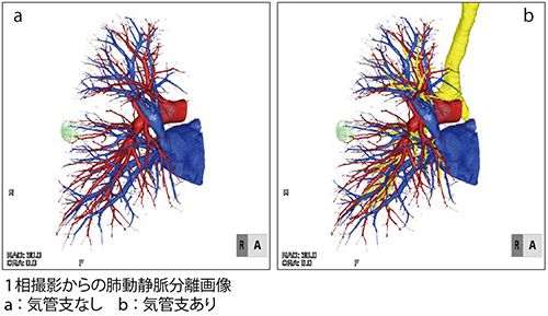 肺動静脈分離画像