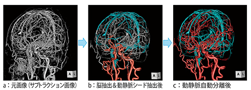 図3　解剖学的認識アルゴリズムを用いた動静脈のシード抽出と血管連続性アルゴリズムを用いた脳動静脈分離