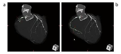 図5　RealiZeを搭載した新しいCT冠動脈解析2