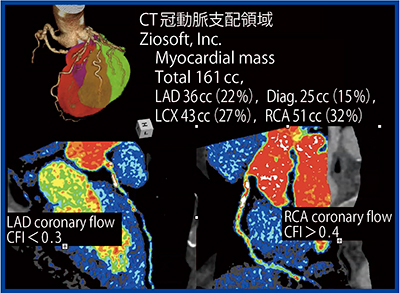 図4　Coronary Flow Imagingの新たな可能性