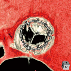 図5　PhyZiodynamicsを使用したTAVR術後の血栓4D画像