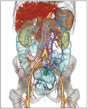 図5　直腸がん術前CTより作成された術前3D画像