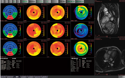図2　‌MR遅延造影解析，MR心筋パフュージョン解析，MR心機能解析のBull’s eye同時表示