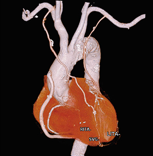 図1　冠動脈バイパス術後患者の自動抽出結果