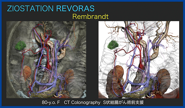 図5　“レンブラント”によるCTCのS状結腸がん術前支援画像