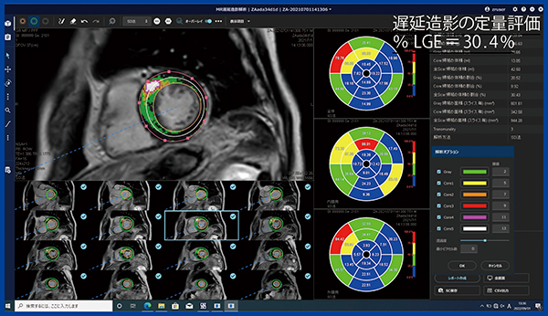 図2　REVORASの“MR遅延造影解析”による肥大型心筋症のLGE定量評価