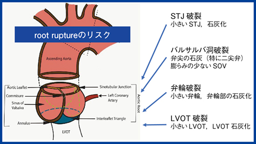 図1　TAVIにおけるroot ruptureのリスク