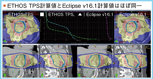 図1　 ETHOS TPSとEclipseの臨床プラン比較