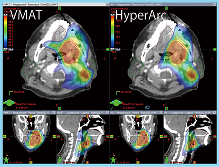 図3　頭頸部がんへのHyperArcの適応