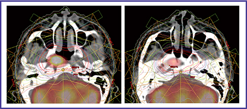 図2　上咽頭癌のPET/CTシミュレーションによる線量分布 CTのみでは進展範囲の同定が困難であった頭蓋底浸潤の範囲が正確に把握できた。
