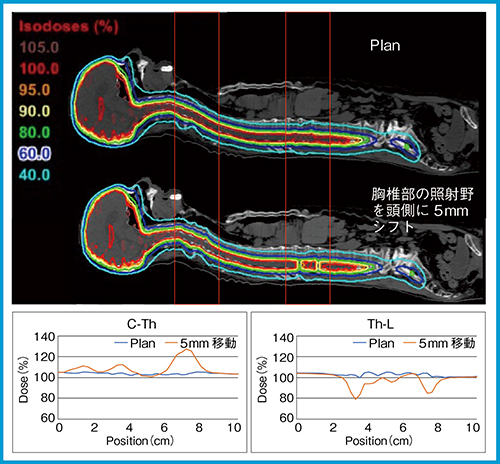 図4　RapidArcにおける全脳全脊髄照射の線量分布と照射野つなぎ目位置の線量プロファイル