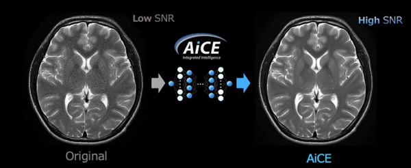 Deep Learningを用いたSNR向上技術Advanced intelligent Clear IQ Engine（AiCE）