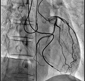 左冠動脈造影画像 ※ノイズが少なく明瞭なコントラストで血管が造影される。