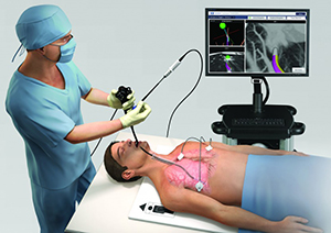患者胸部を電磁場中に位置させ，気管支鏡のワーキングチャネルに磁器センサを備えたカテーテルを挿入。迷路のように分岐する肺末梢部でリアルタイムに位置を表示して，病変近傍まで正確に誘導