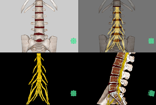 CTの骨画像とMRIの腰神経画像をフュージョンすることで，相互の位置関係が確認できる