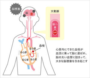 図2：心房細動が脳梗塞を引き起こす仕組み（心原性脳塞栓症）