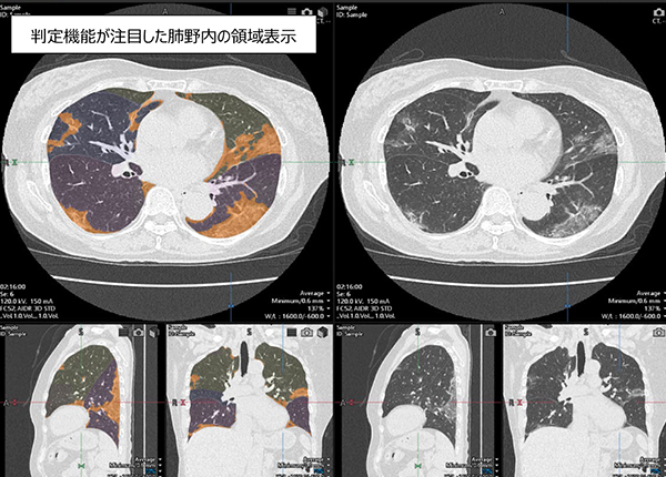「COVID-19肺炎解析ソフトウェア」の解析結果を表示するワークステーション画面例