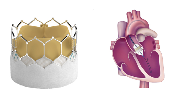 左：サピエン 3 Ultra RESILIA生体弁の写真　右：カテーテルを用い，血管から大動脈弁の位置まで人工弁を運び，バルーンを膨らませて留置する