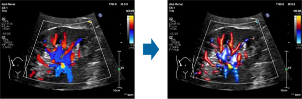 「Flow Viewer」による腎臓の血流イメージ：使用前（左）と使用後（右）