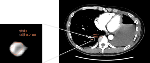 造影CT画像で肺動脈低吸収値強調フィルタを用いた表示。