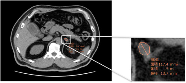 非造影CT画像で副腎吸収値強調フィルタを用いた表示。