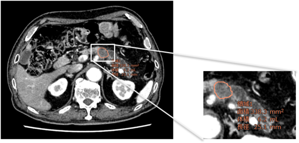 造影CT画像で，膵臓吸収値強調フィルタを用いた表示。自動で計測を実施。