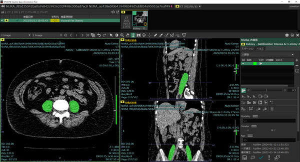 アノテーション作業画面 臨床現場で使用されている「SYNAPSE SAI viewer」と画面デザインを同様にしたことにより，効率的かつ直感的なアノテーション作業が可能。