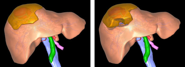 任意の点で変形を行った肝臓の3D画像
