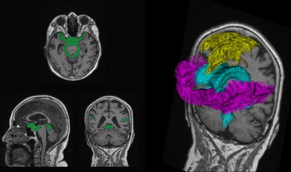 DESHに関係する各領域を自動で抽出 黄色：高位円蓋部・正中のくも膜下腔，水色：脳室，赤紫色：シルビウス裂・脳底槽
