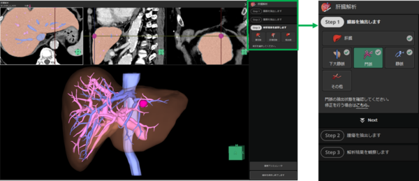 画面右側のリストの説明に従ってボタンを押下していくことで，簡便に肝臓の術前シミュレーションが可能