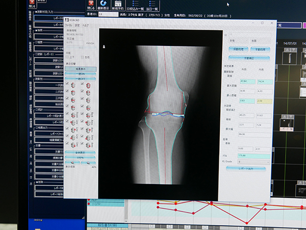 KOACADでの変形性膝関節症を自動抽出