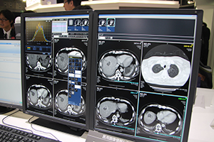 RapideyeCoreの画像ビューワの腫瘍の自動認識・計測機能