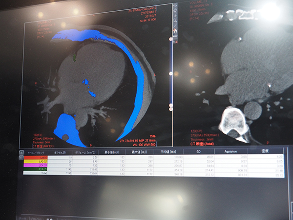「CT石灰化スコアリング」での冠動脈石灰化の自動解析画面