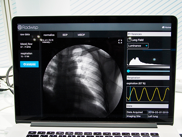 肺野のX線透視画像から動態解析を行う“Radwisp”