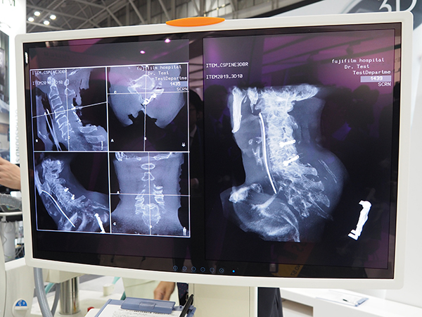 高精度の術中の3D画像で脊椎の固定術などの手技をサポート