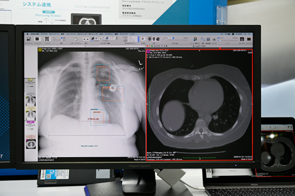 胸部CT画像からCT値の上昇領域をROI表示する「Plus.Lung.Nodule」（写真左）と「Plus.CXR」（写真右）