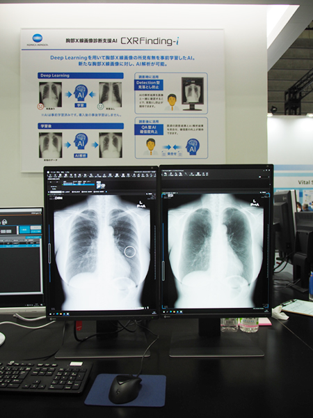胸部X線画像診断支援AIソフトウエア「CXR Finding-i」での病変検出の一例