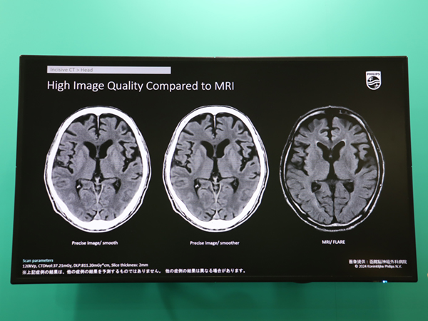 頭部においてはMRIライクな画像を取得可能（右端はMRI FRAIR画像）